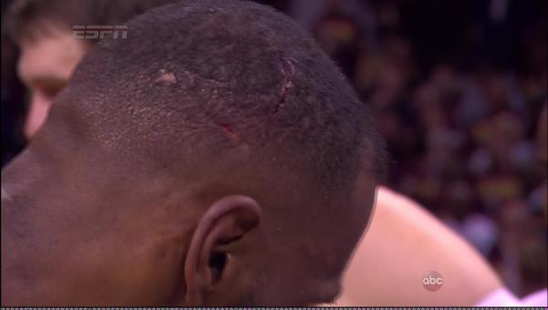 Blessure à la tête de LeBron James